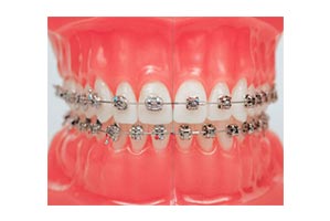 Metal braces