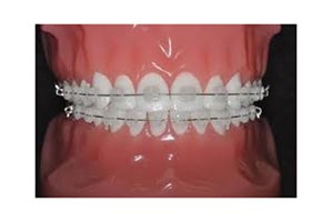 colored braces
