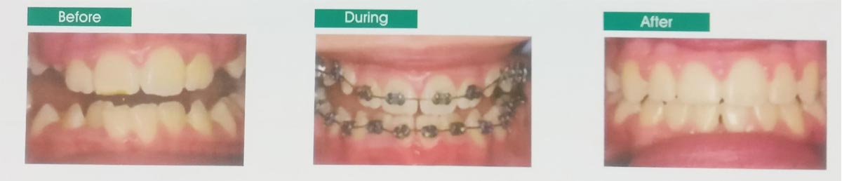 metal braces process