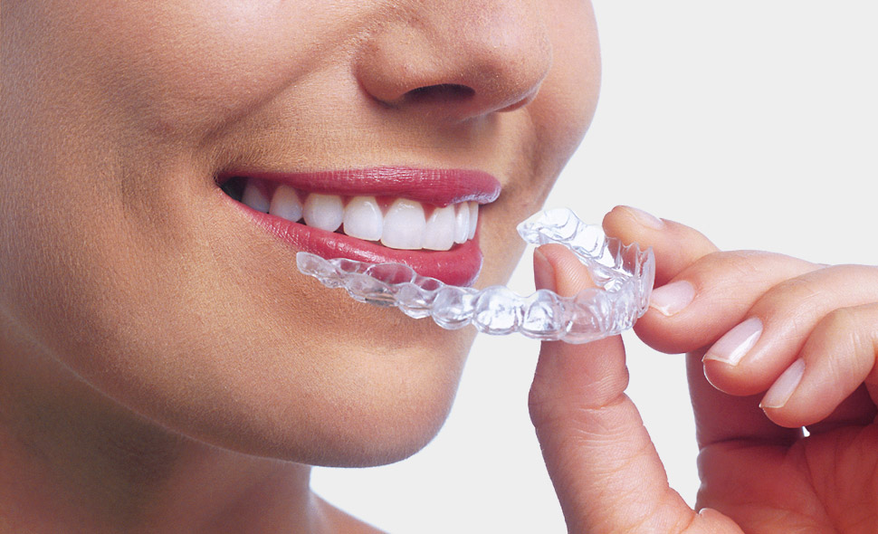 How Long Does It Take for Braces to Close a Gap Between Teeth?