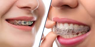 Clear Aligner Braces vs Traditional Braces – What’s Better For You?